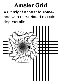 Illustration of Amsler grid as it may appear to someone with age-related macular degeneration