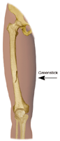 Illustration of greenstick fracture
