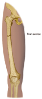 Illustration of transverse fracture