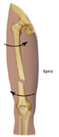 Illustration of spiral fracture