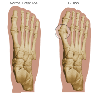 Illustration of a normal great toe and a great toe with a bunion