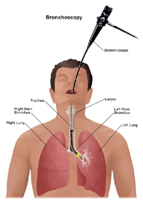 Illustration of bronchoscopy procedure