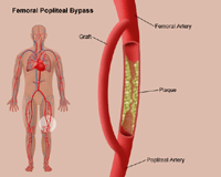 Illustration of femoral popliteal bypass