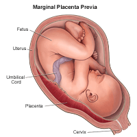 Illustration of marginal placenta previa