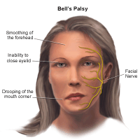 Illustration of Bell's Palsy