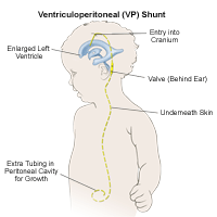 Illustration demonstrating ventriculoperitoneal shunt placement