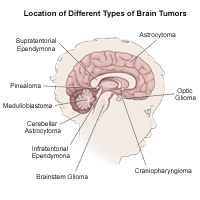 Illustration of the brain detailing common tumor sites, child