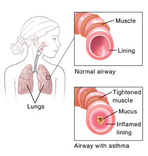 Outline of child with showing respiratory system. Insets show normal airway and airway with asthma.