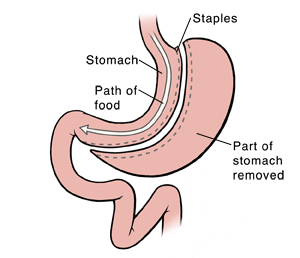 Front view of stomach and first part of small intestine. Stomach has been cut to form small pouch at top. Rest of stomach is removed. Staples close off cut edges. Arrow shows path of food from small pouch to small intestine.