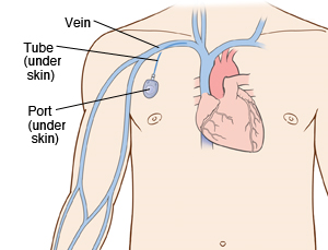 Outline of man's chest showing heart inside. Port is under skin of upper right chest. Tube from port is inserted into vein leading to heart.