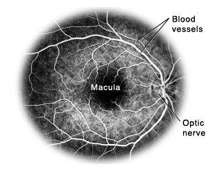 Flourescein angiogram showing blood vessels, macula, and optic nerve.