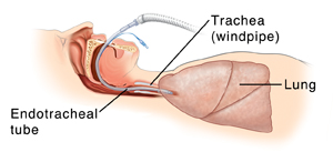 Side view of head and chest showing endotracheal tube in place.