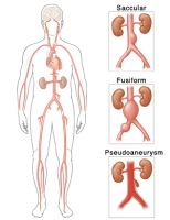 Different types of aortic aneurysms