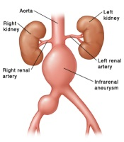 Infrarenal aneurysm