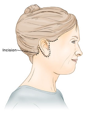 Side view of woman's head showing incision for rhytidectomy (facelift).
