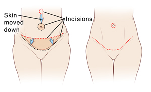 Two images of female abdomen: First image shows incisions and tissue removed for abdominoplasty. Second image shows final result of abdominoplasty.