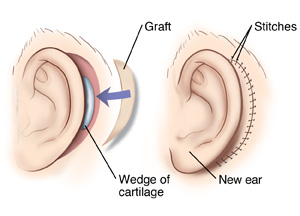 Two images showing the side view of an ear reconstruction. Image one shows a wedge of cartilage inserted behind the ear. Image two shows a skin graft used to cover the insertion site.