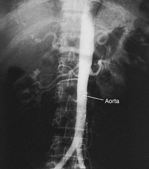 Angiogram of normal aorta.