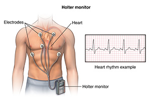 Illustration showing a male torso. Leads are attached to his chest. They are connected to a holter monitor that is clipped to the waistband of his pants.