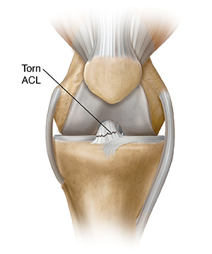 Front view of knee joint showing tear in anterior cruciate ligament.