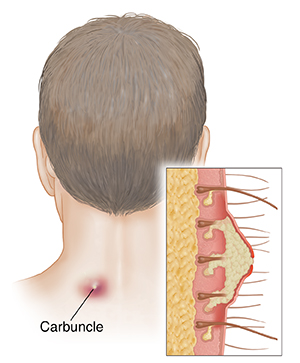 Understanding Carbuncles