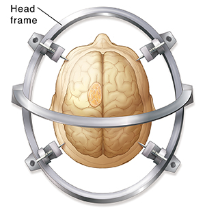 Top view of head inside stereotactic frame. Brain and tumor are ghosted in.