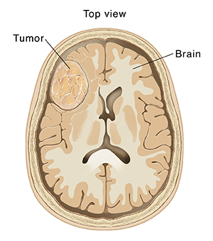 Top view cross section of brain showing tumor.