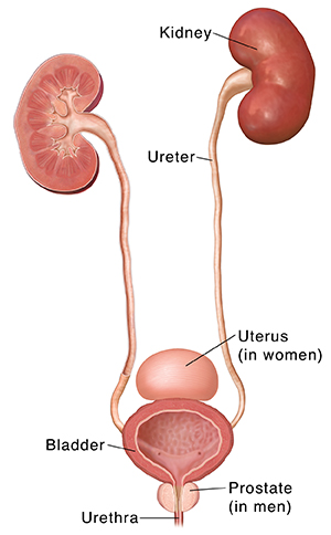 What Is a Urostomy?
