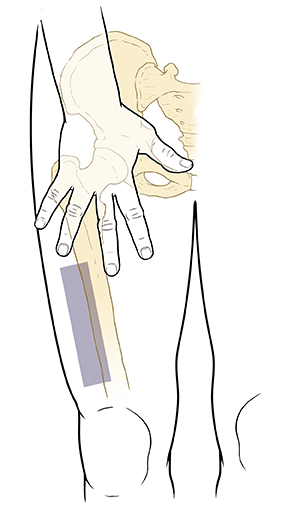 Discharge Instructions: Giving Yourself an Intramuscular (IM) Injection