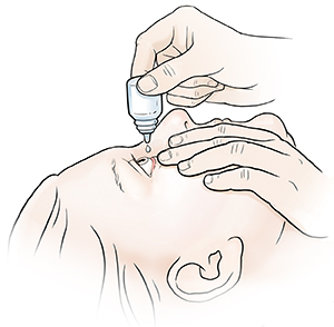 Woman leaning head back and pulling gently down on lower eyelid. Other hand is holding eyedrops bottle over eye. 