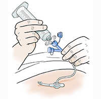 Hands connecting syringe to port on feeding tube.