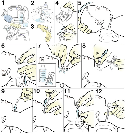 StepbyStep Changing a Child's Tracheostomy