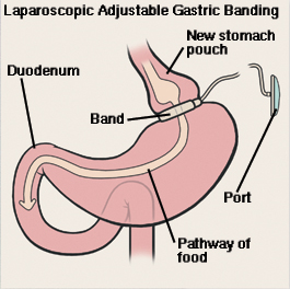 Front view of stomach and duodenum showing laparoscopic adjustable gastric banding. Band is around top of stomach, creating small pouch. Band is connected by tube to port just under skin. Arrow shows path of food through stomach pouch, stomach, and duodenum.