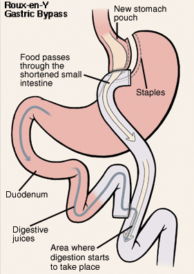 Front view of stomach and duodenum. Stomach has been cut and stapled to form pouch. Cut end of small intestine has been brought up to connect to stomach pouch. Duodenum has been cut and reattached to small intestine. Arrow shows food passing from stomach into shortened small intestine. Another arrow shows path of digestive juices from stomach through duodenum and into small intestine. Digestion begins in small intestine.
