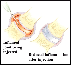 Inflamed joint being injected and image showing joint with reduced inlammation after injection.