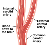 A healthy carotid artery lets blood flow easily to the brain.