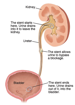 Ureteral Stents