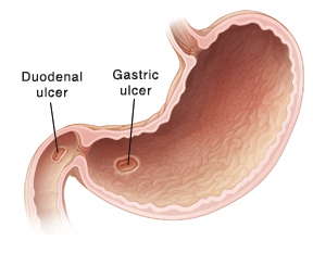The ulcer may be located anywhere in the stomach or duodenum.