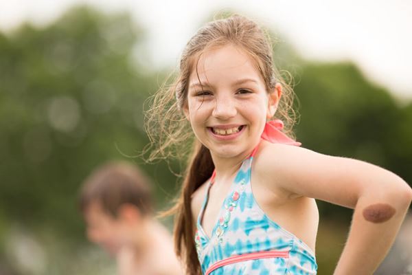 girl with brown hair with a birthmark near her elbow