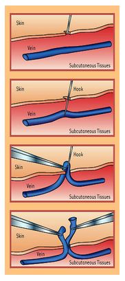 Microphlebectomy Vein Treatment