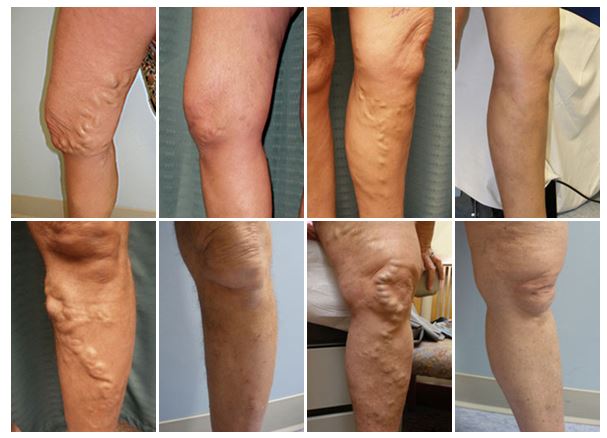 Vein Treatment Before and After Photos