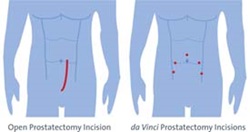 portrayal of incision sites for prostate robotic surgery