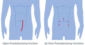 portrayal of incision points for robotic surgery of the prostate