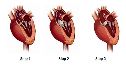 Illustration of three steps involved in TAVR procedure