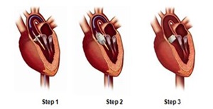 Image of the three steps for a TAVR procedure