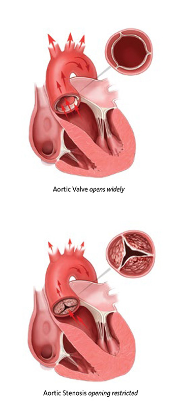 aortic valve healthy and diseased