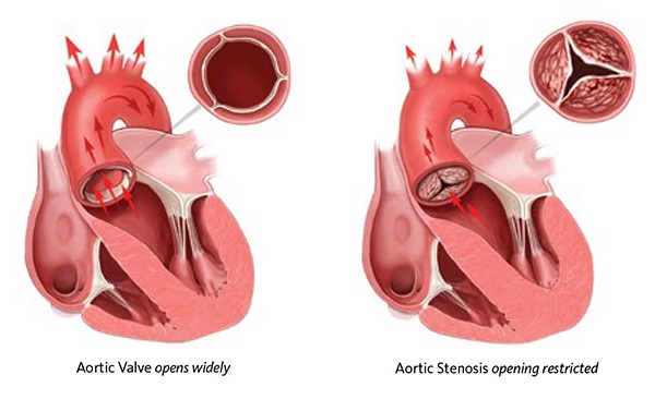 aortic valve healthy and diseased