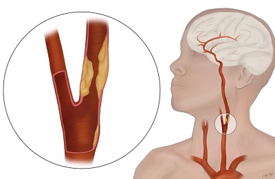 Illustration showing carotid artery stenosis